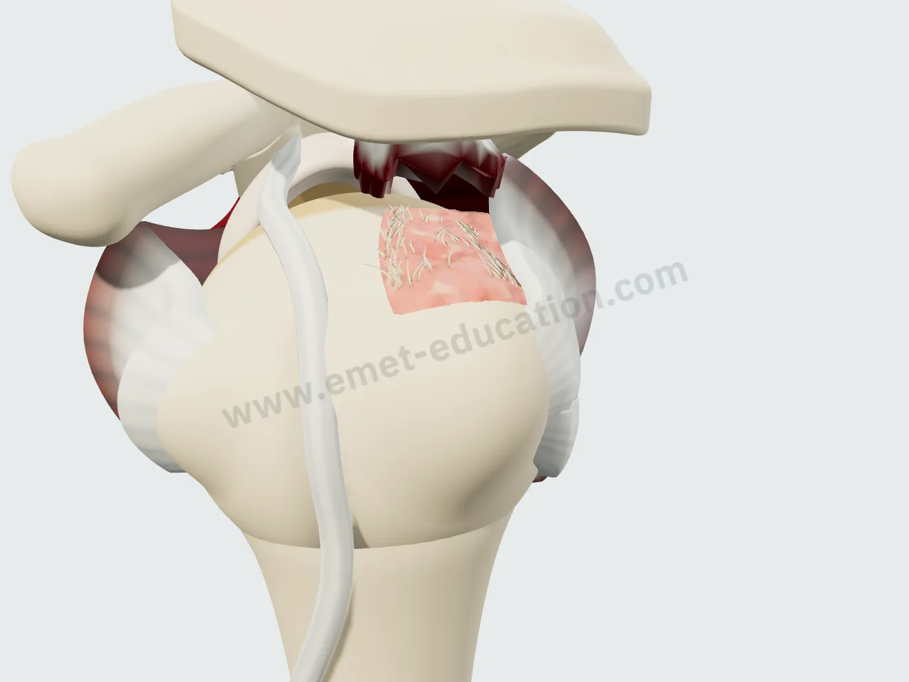 Supraspinatus tear retracted to the top of the humeral head (stage 2): the greater tuberosity footprint exposed.