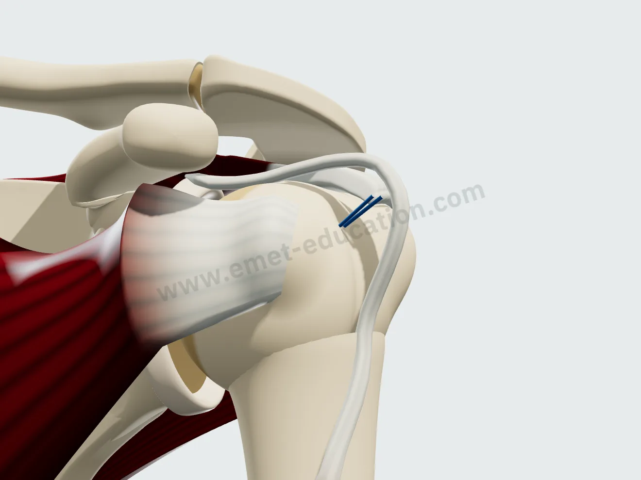 Biceps tenodesis, step 1: tendon lifted, anchor inserted at the floor of the bicipital groove.