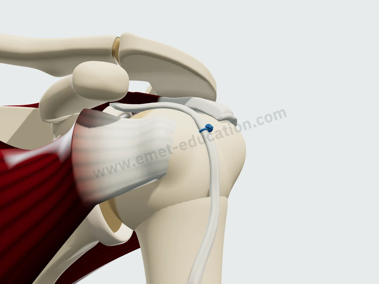 Biceps tenodesis, step 2: the tendon placed back in the groove and tied over the anchor.