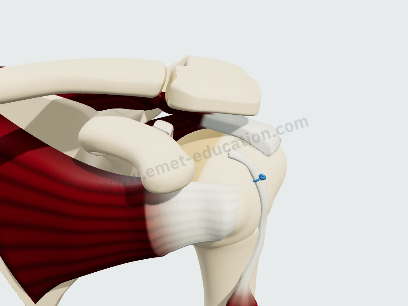 Biceps tenodesis, step 3: the intra-articular portion removed, a short stump on the glenoid.