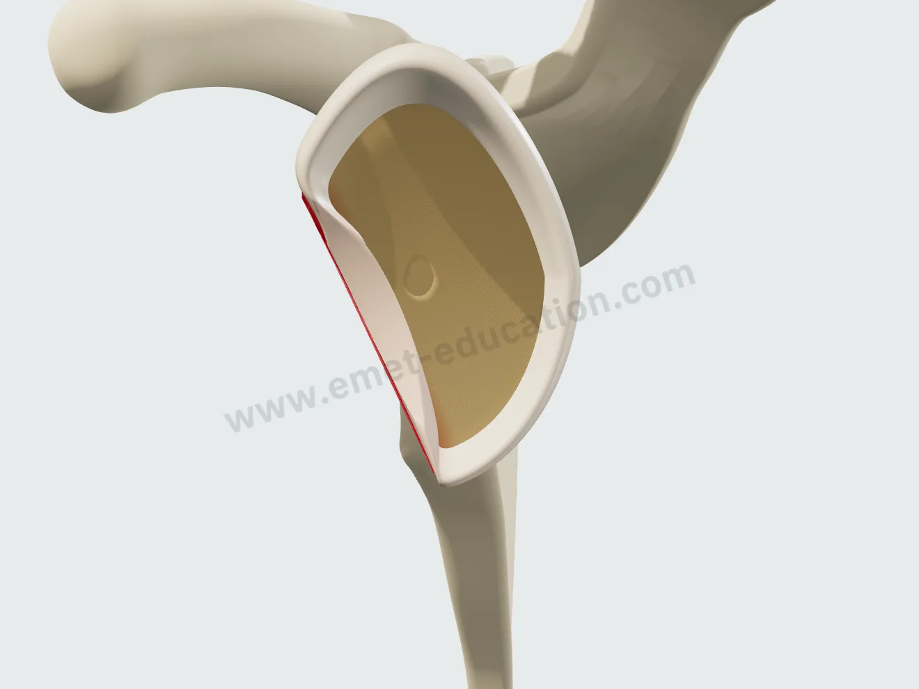 En face glenoid: 30% anteroinferior bone loss, the lower half of the glenoid narrowed.