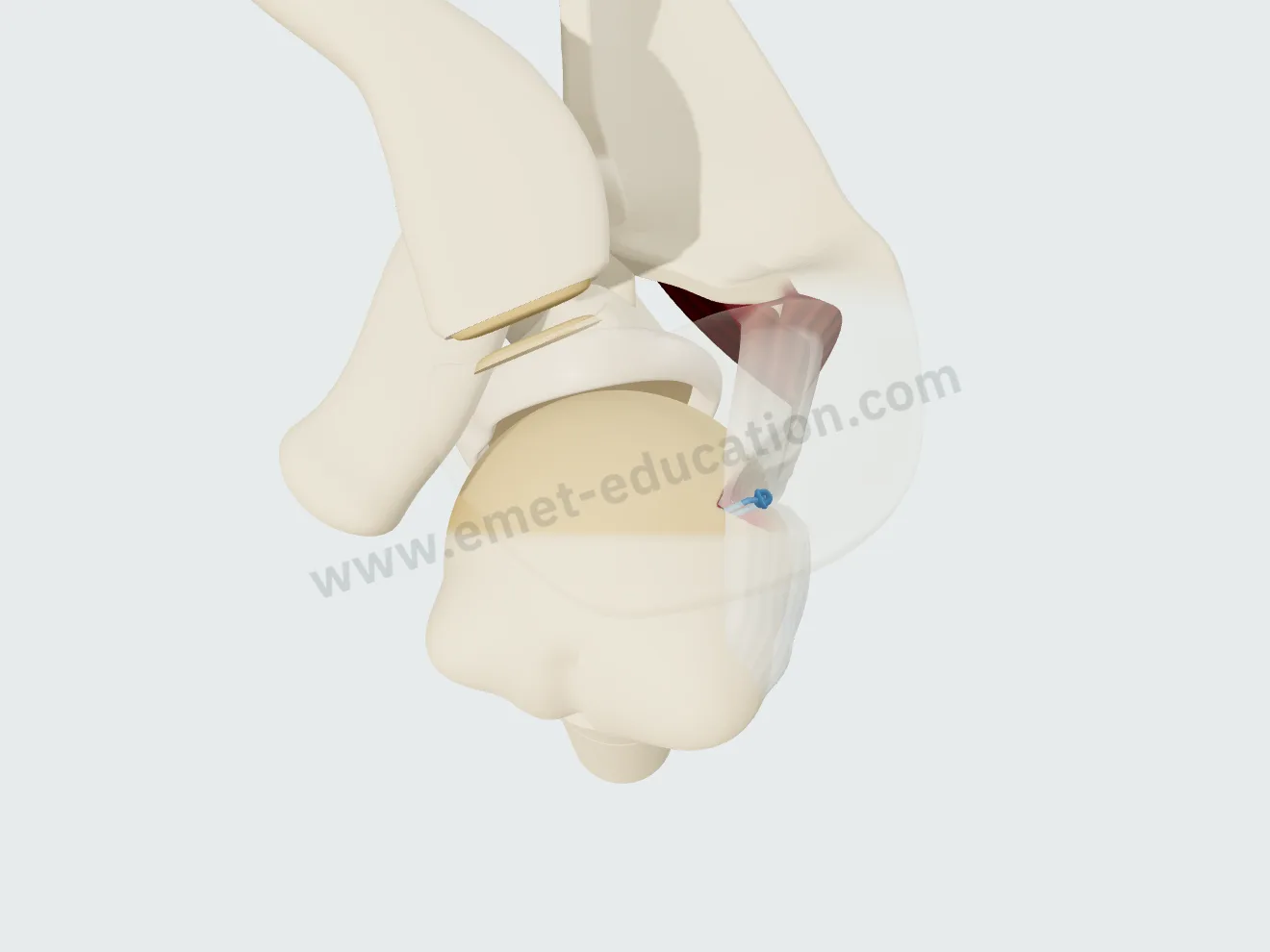 Remplissage, step 4: top view, knot tied, the tendon pressed into the defect, filling it.