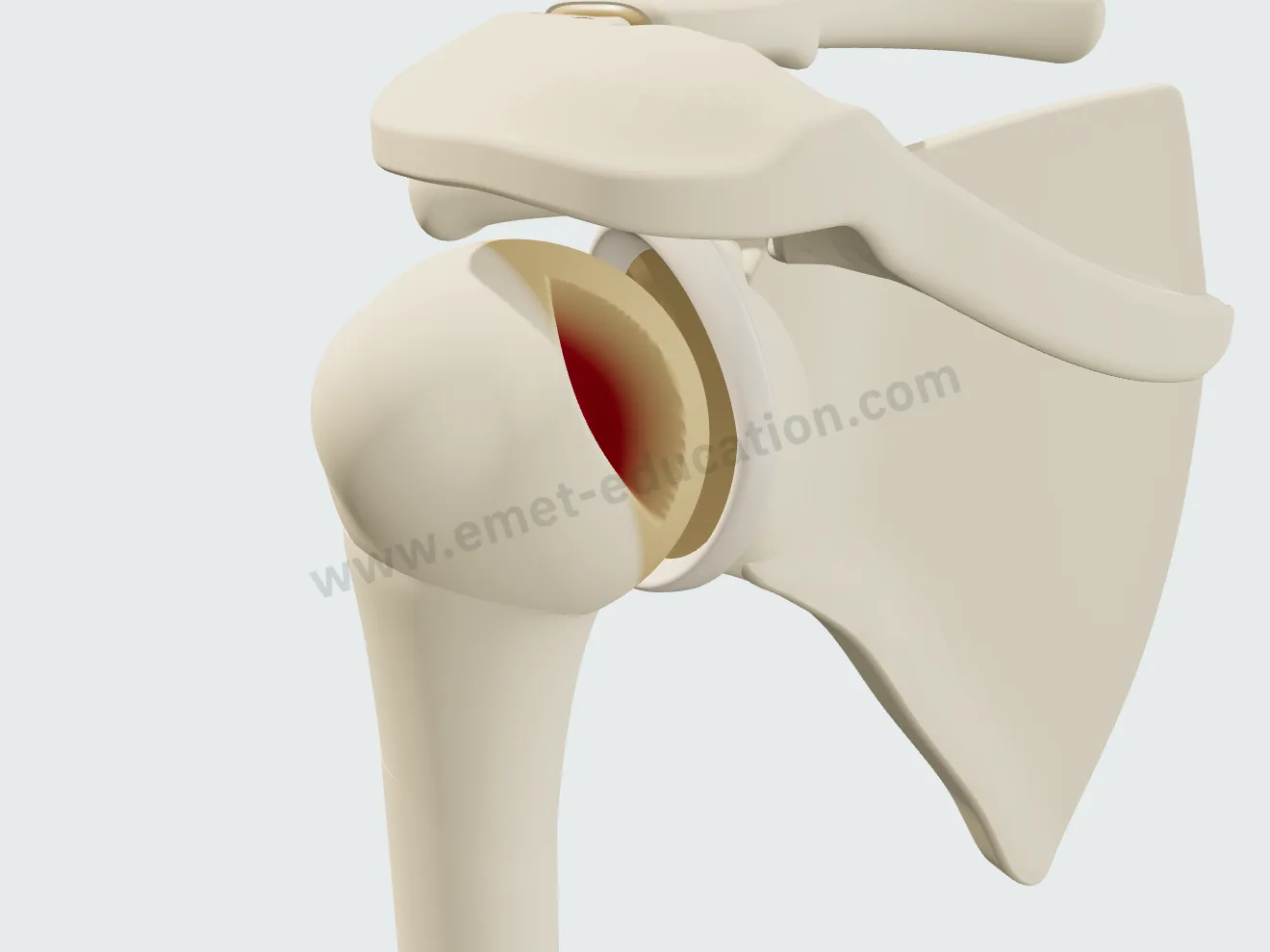 Posterior view: large Hill-Sachs lesion, steep medial wall.