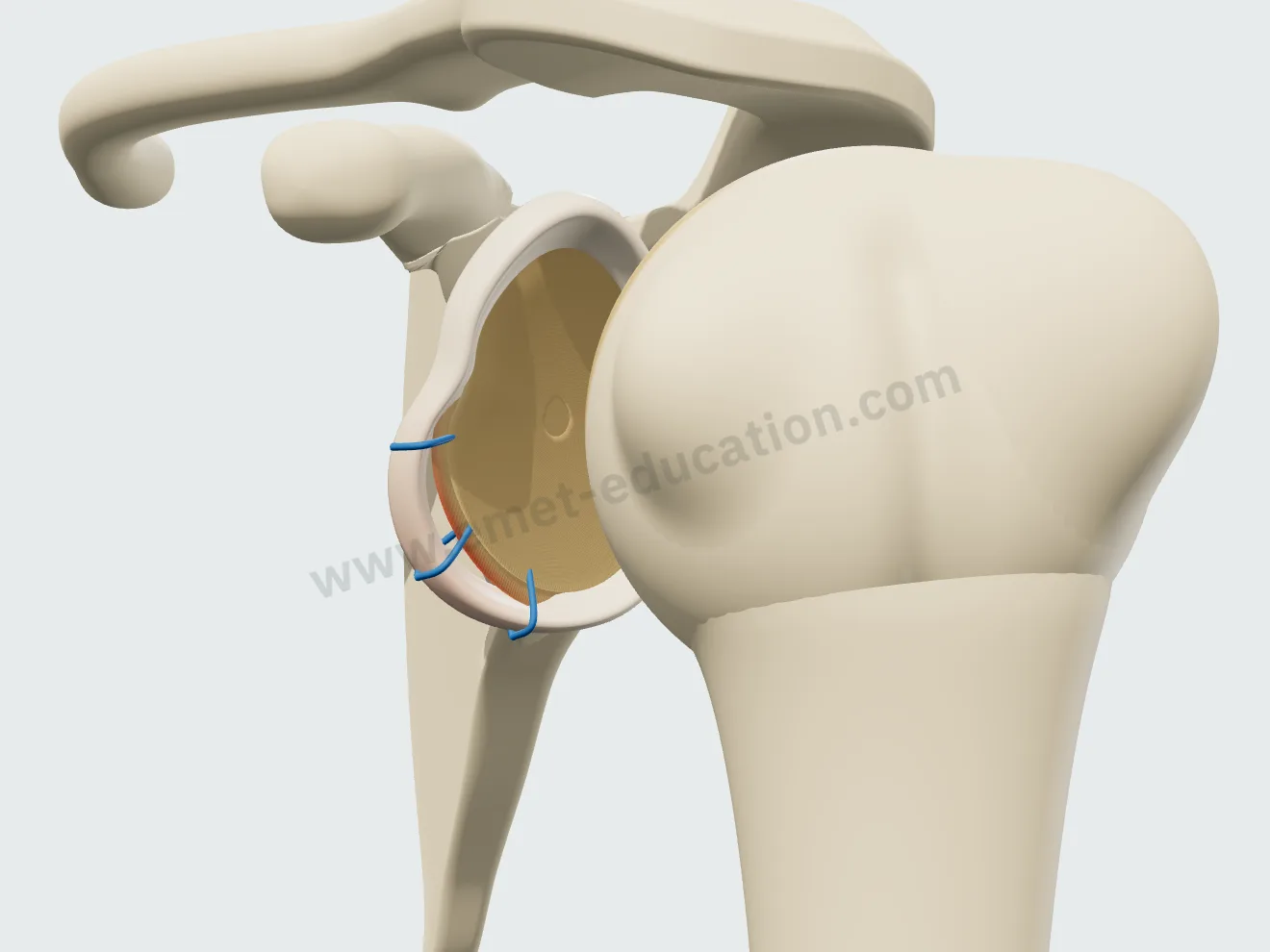 Labral repair, step 2: the sutures passed around the detached labrum.