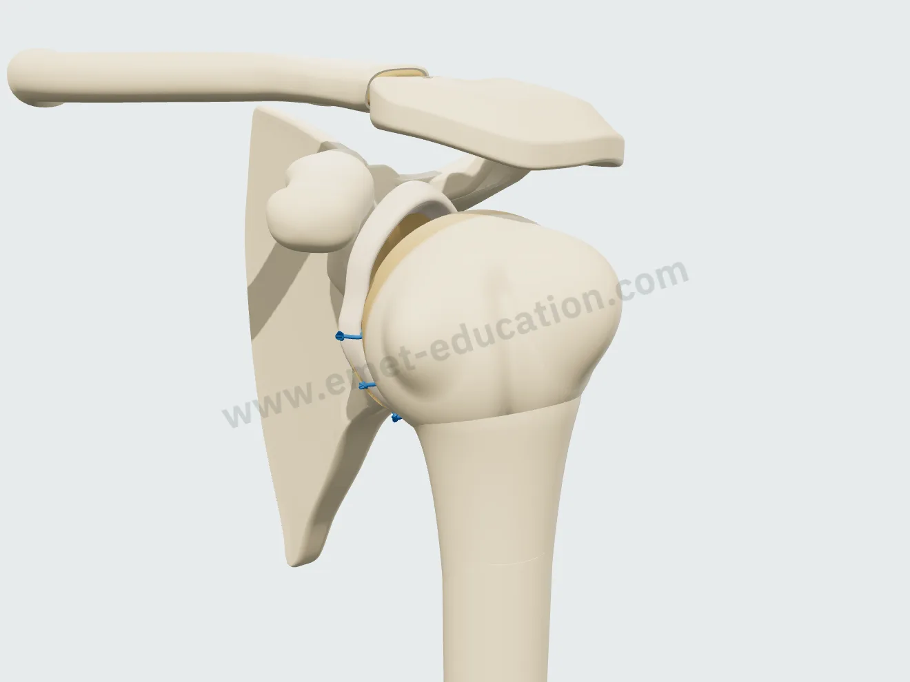 Labral repair, step 4: the humeral head back in place, shoulder stabilized.