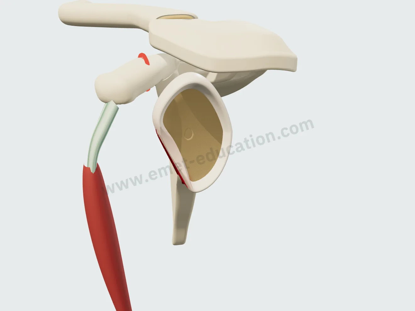 Latarjet procedure, step 2: coracoid osteotomy, the conjoint tendon attached to the graft.