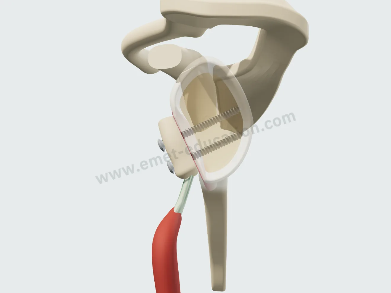 Latarjet procedure, step 5: the bone block in place, the anteroinferior glenoid rim restored.