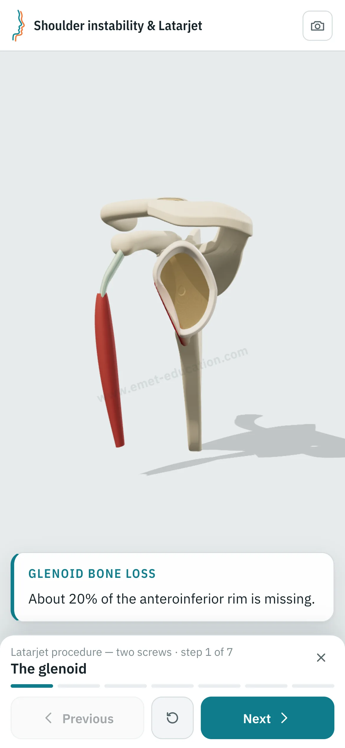 Patient view on a phone: the Latarjet procedure replayed step by step.