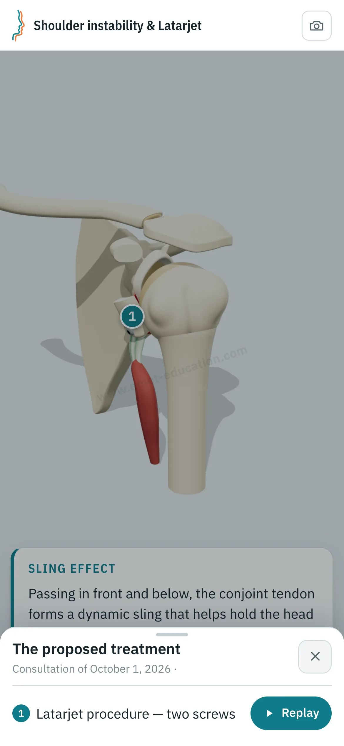 Patient view on a phone: the shoulder after a Latarjet procedure fixed with two screws, and the “The proposed treatment” panel open, with the “Replay” button.