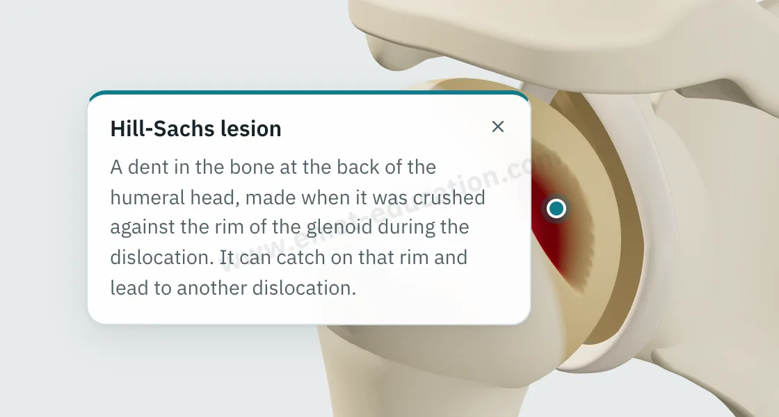 Explanation bubble “Hill-Sachs lesion” shown after tapping the defect at the back of the humeral head.