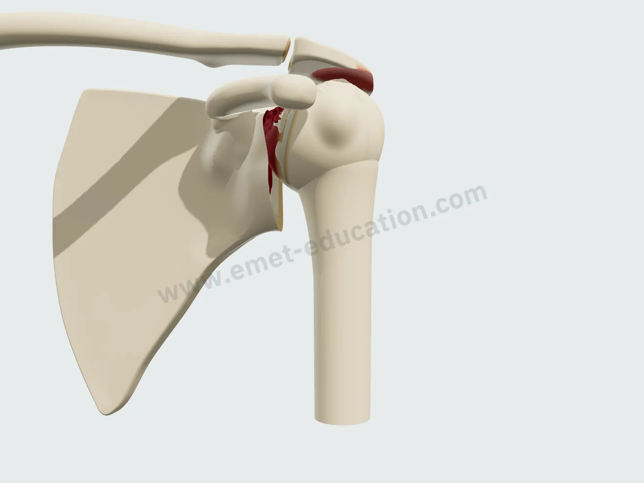 Shoulder from the front with Hamada grade 5 eccentric osteoarthritis, before reverse arthroplasty: head migrated up under the acromion.