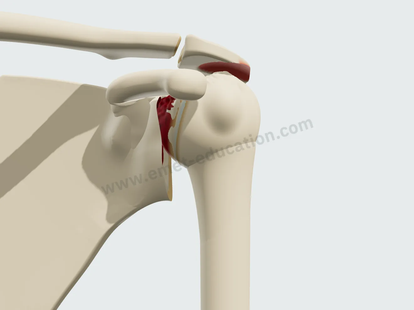 Hamada grade 5: the top of the humeral head collapsed and irregular under the acromion.