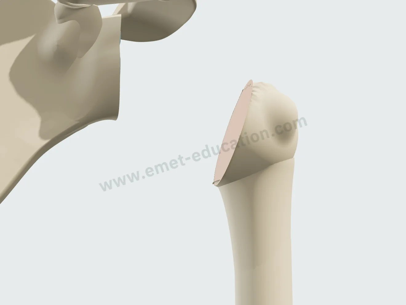 Hemiarthroplasty, step 1: shoulder dislocated, head resected at the anatomic neck.