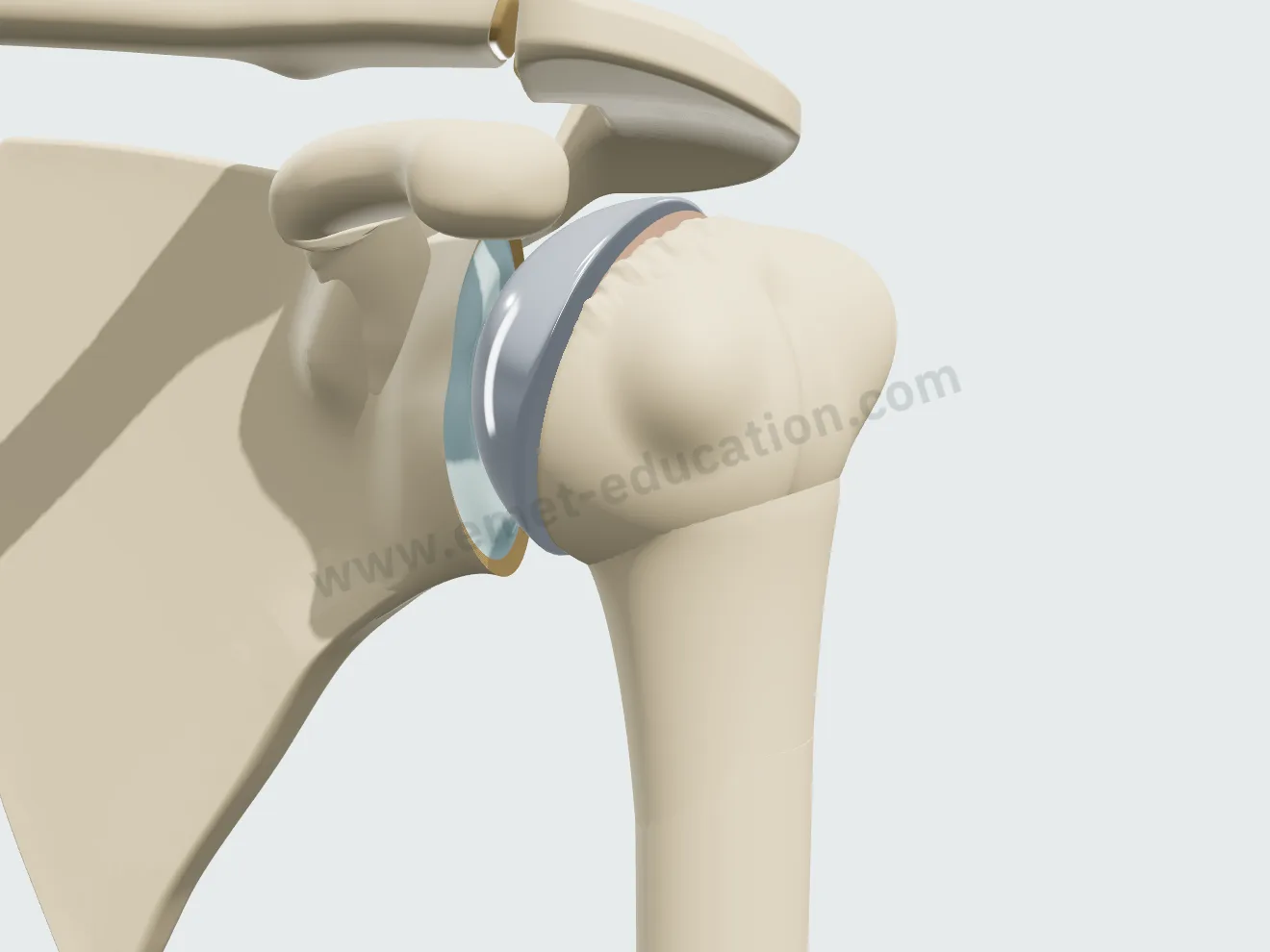 Hemiarthroplasty, step 2: metal head in place, shoulder reduced against the preserved glenoid.
