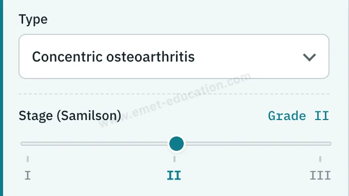 Model panel: “Concentric osteoarthritis” type, Samilson gauge at grade II.