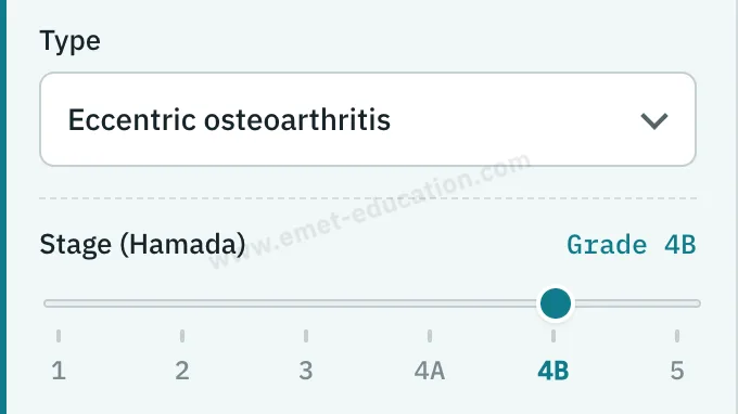 Model panel: “Eccentric osteoarthritis” type, Hamada gauge at grade 4B.