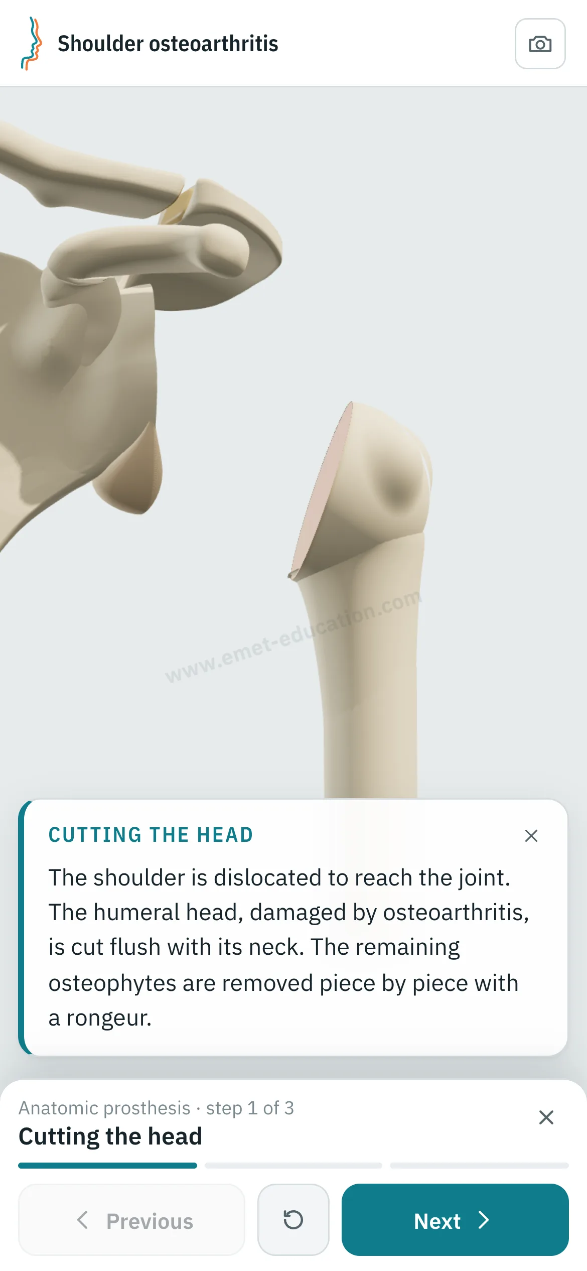 Patient view on a phone: the anatomic arthroplasty replayed step by step.