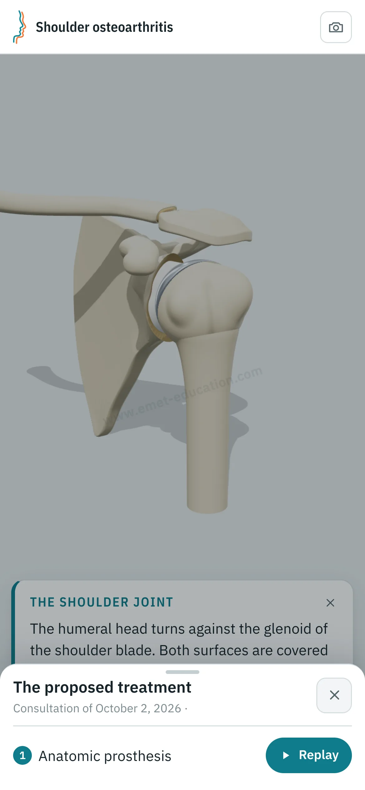 Patient view on a phone: the shoulder after anatomic arthroplasty, and the “The proposed treatment” panel open, with the “Replay” button.
