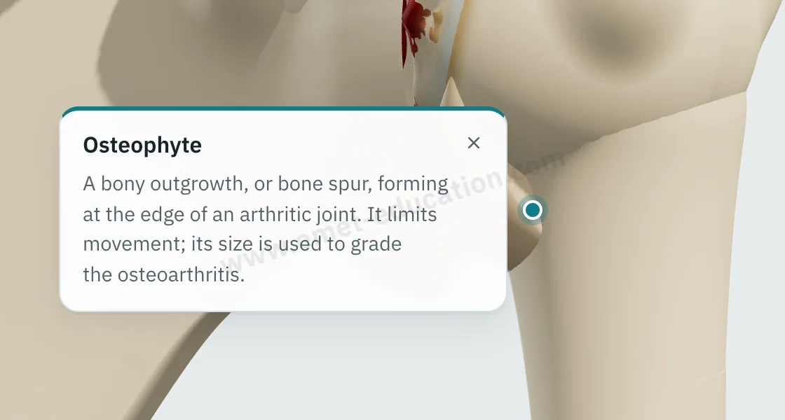 Explanation bubble shown after tapping the humeral osteophyte, below the head.