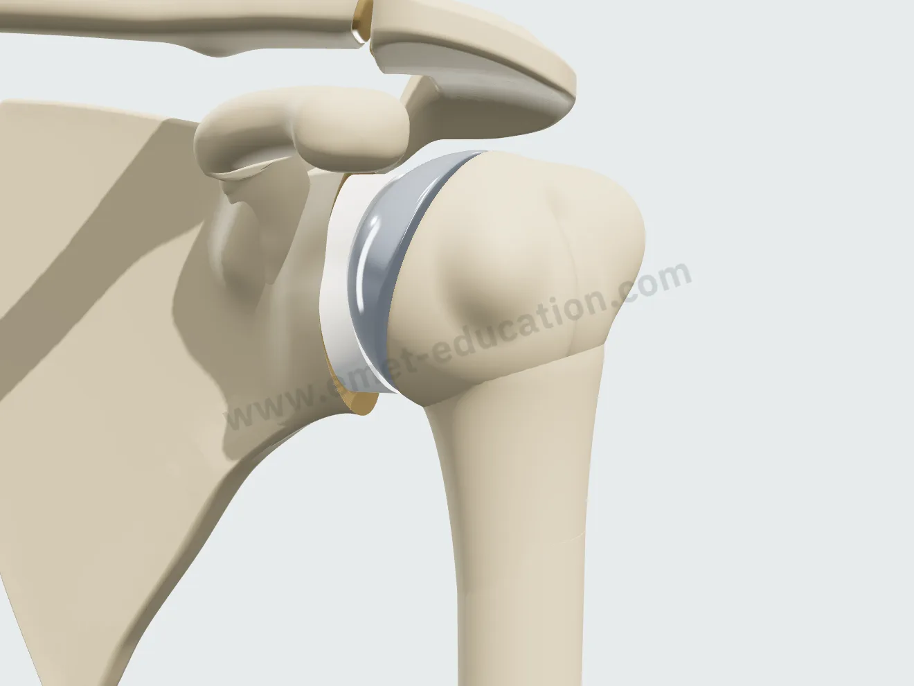 Anatomic arthroplasty, step 3: metal head on its stem, shoulder reduced.