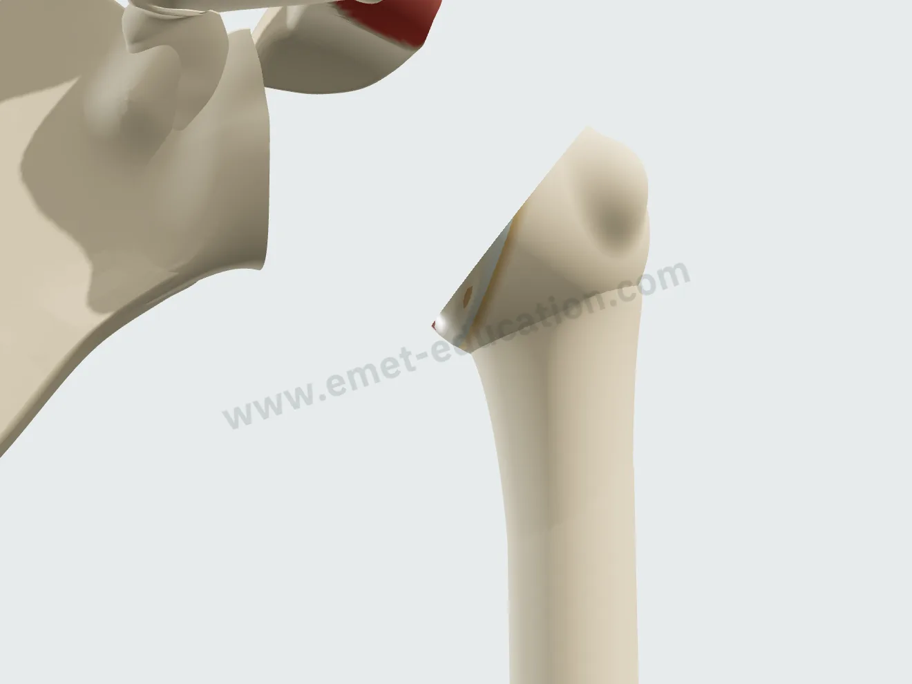 Reverse arthroplasty, step 1: humeral head resected, shoulder dislocated.