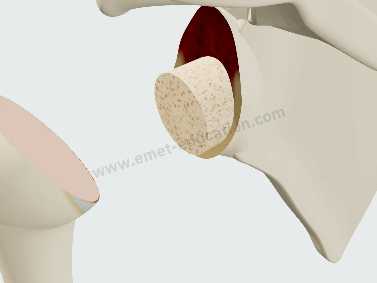 Reverse arthroplasty, step 2: the bone graft seated on the glenoid, filling its wear.