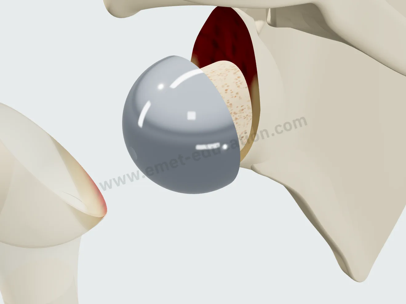 Reverse arthroplasty, step 3: baseplate screwed through the graft, metal glenosphere in place.