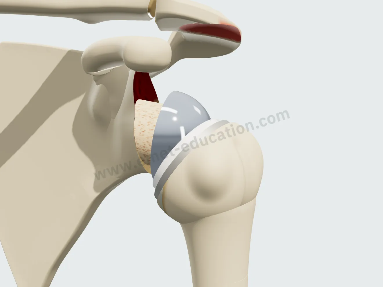 Reverse arthroplasty, step 4: the humeral cup covers the glenosphere, shoulder reduced.