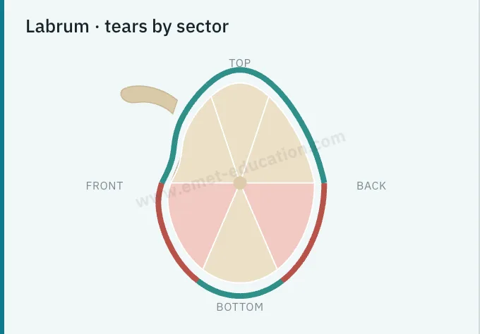 Model panel: the small glenoid diagram in six sectors, anteroinferior and posteroinferior sectors torn.