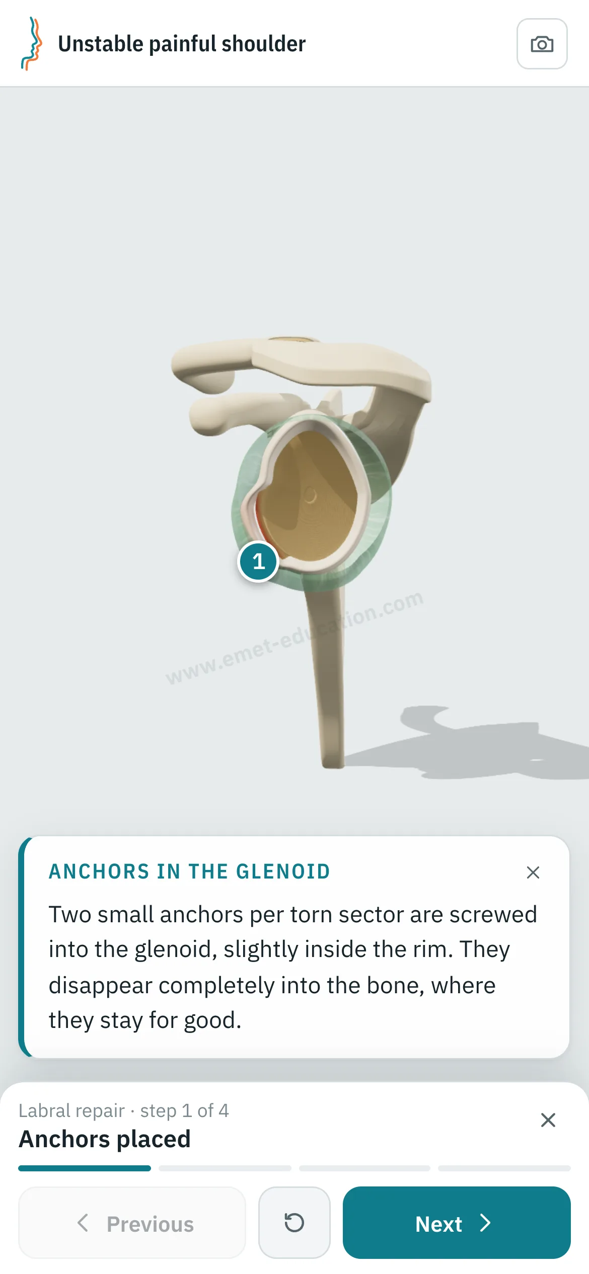 Patient view on a phone: the labral repair replayed step by step.