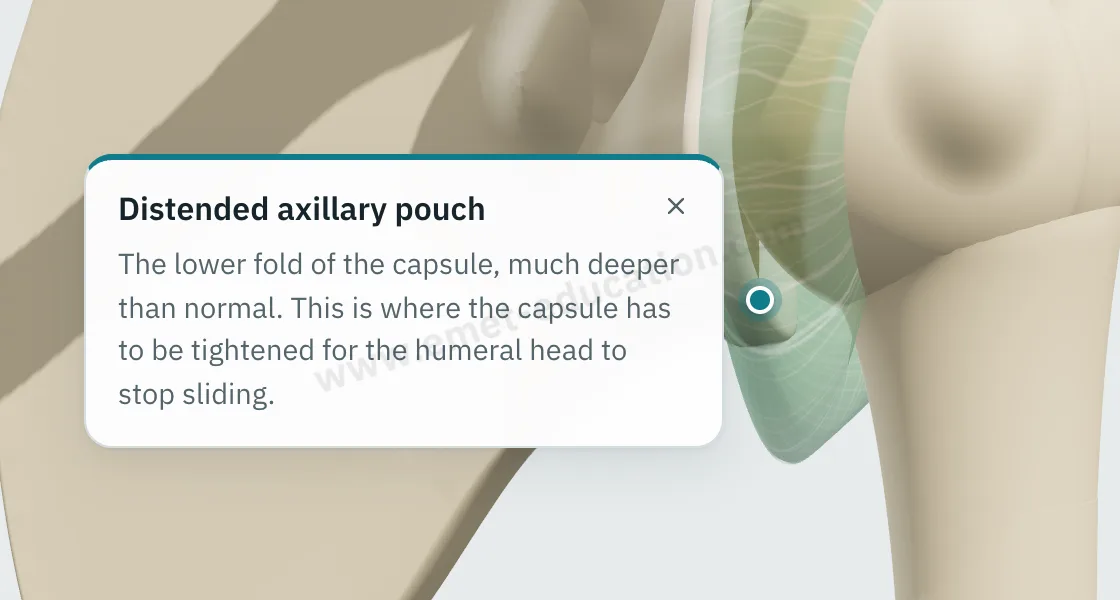 Explanation bubble about the distended axillary recess, shown after tapping the capsule below the humeral head.