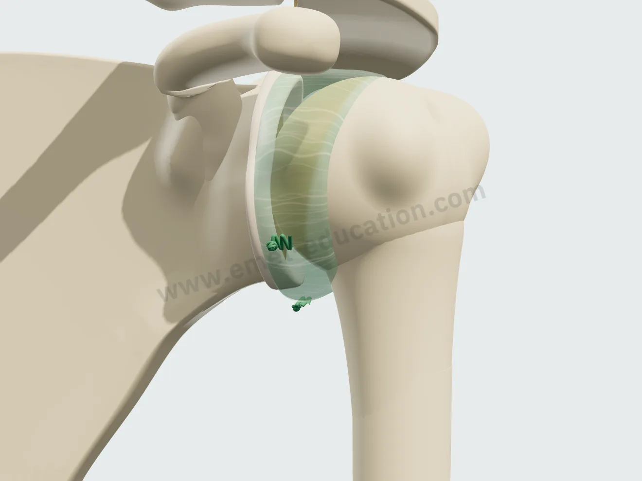 Capsular plication, step 3: the stability test, the head now slides only 10 to 20%.