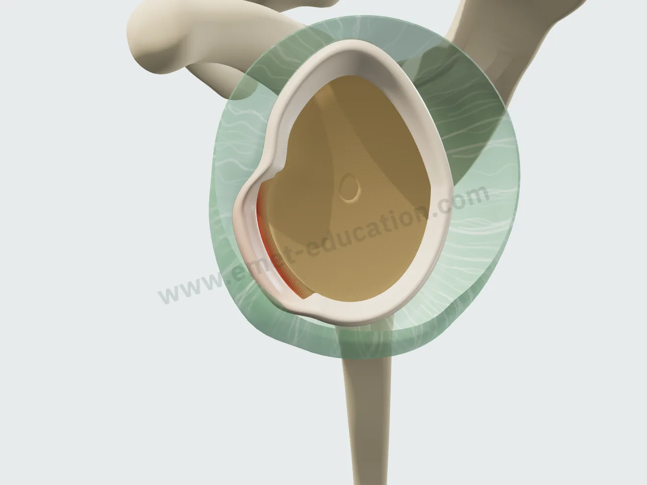 Labral repair, step 1: two anchors inserted into the anteroinferior glenoid rim.