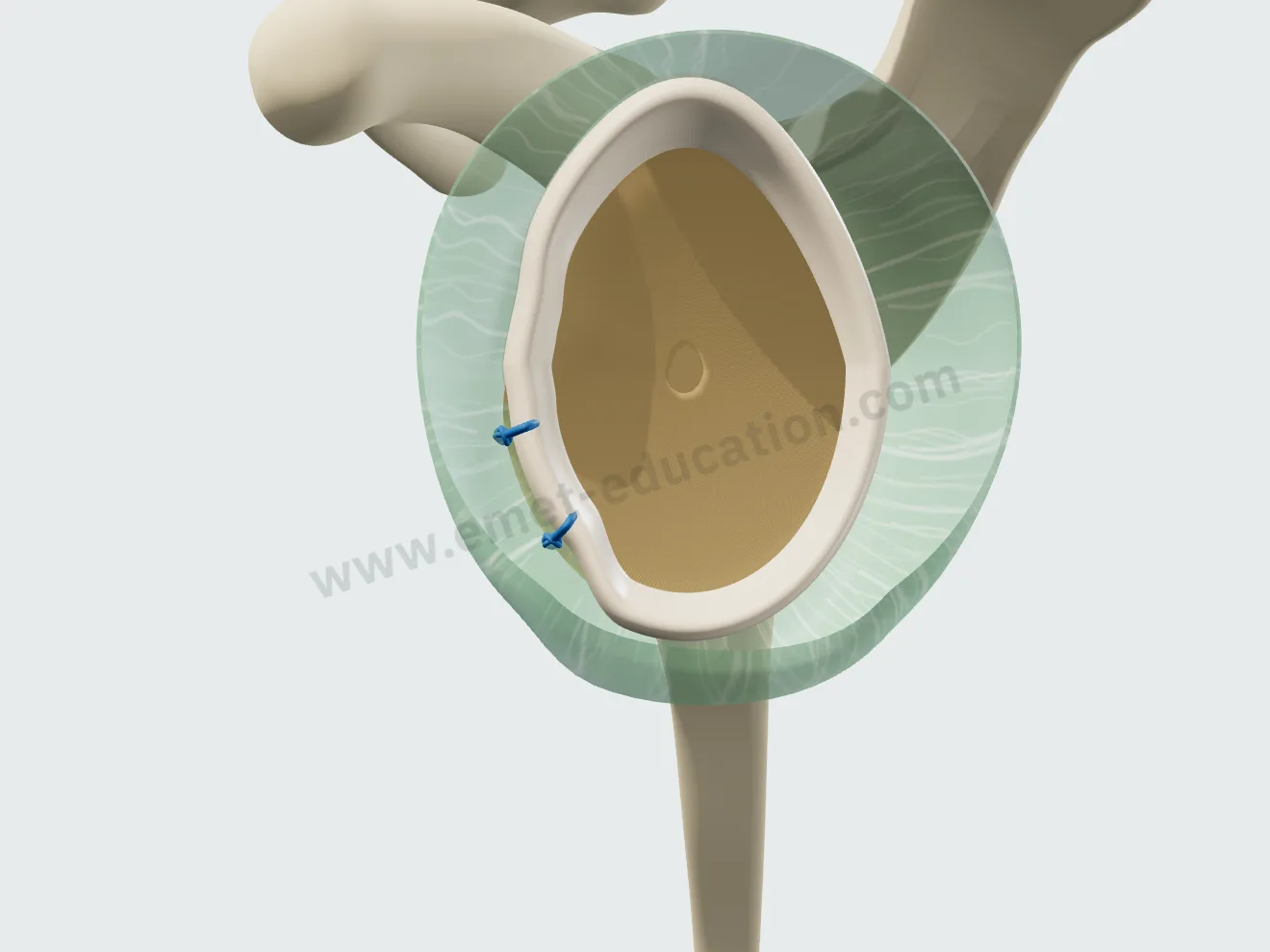 Labral repair, step 3: knots tied, the labrum pressed back against the rim.