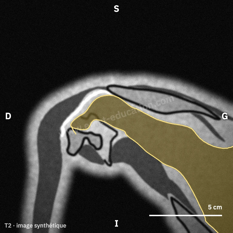 Synthetic MRI, posterior oblique coronal view: the infraspinatus from the fossa to the greater tuberosity.