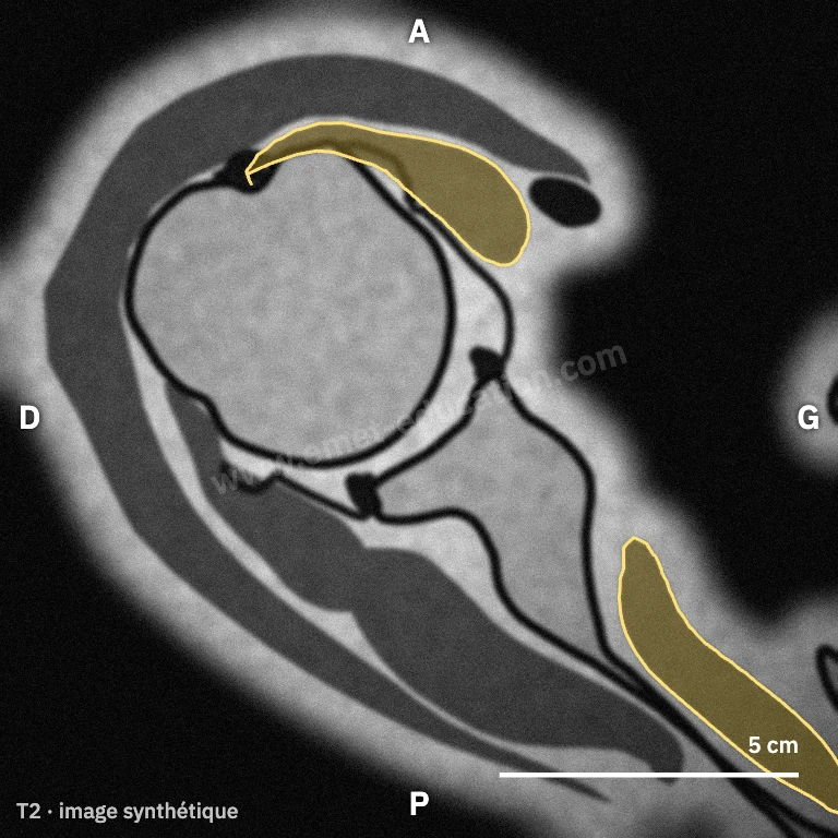 Synthetic MRI, axial view at the center of the head: subscapularis tendon in front of the head, muscle belly medially.