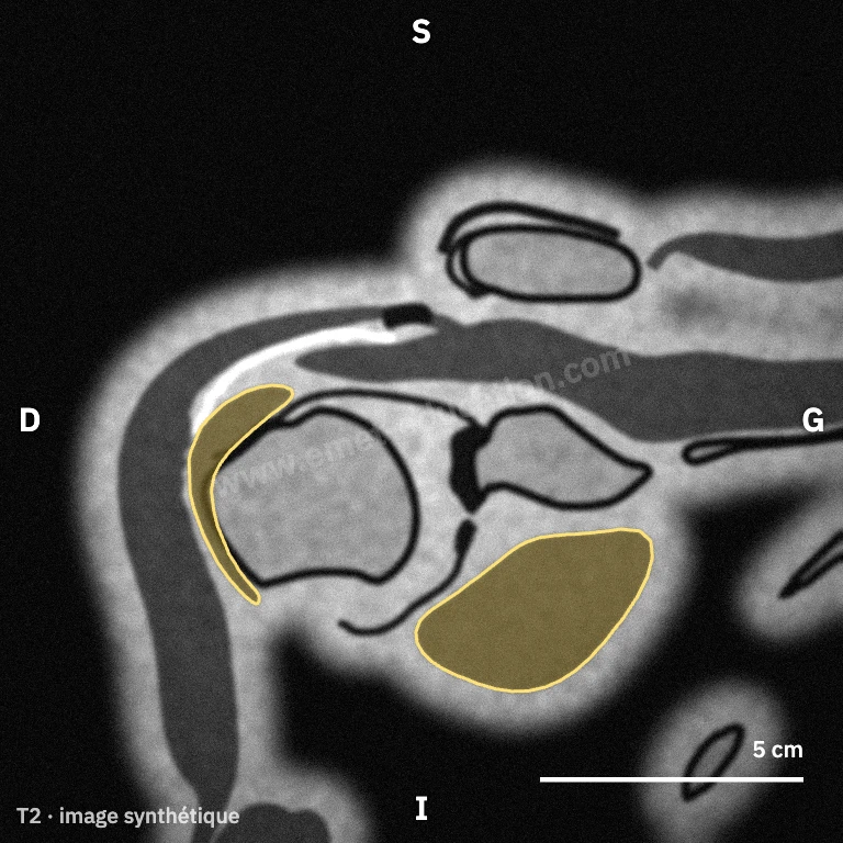 Synthetic MRI, anterior oblique coronal view: the subscapularis below the glenoid and its tendon at the lesser tuberosity.