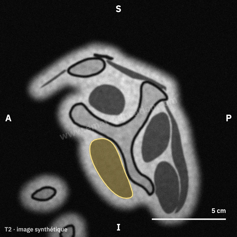 Synthetic MRI, oblique sagittal Y view: subscapularis in front of the scapular body.