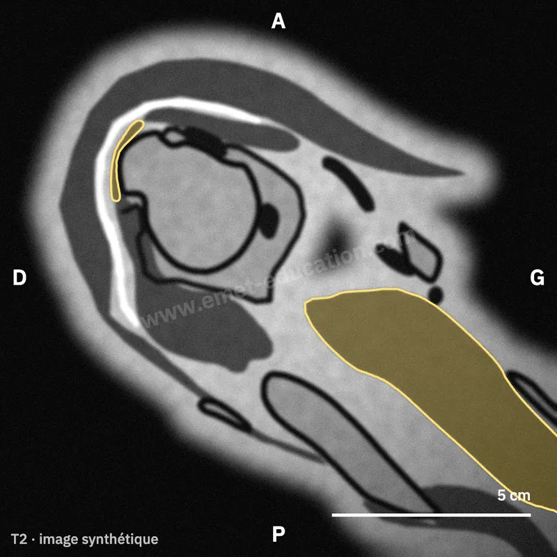 Synthetic MRI, axial view above the humeral head: supraspinatus belly and tendon.