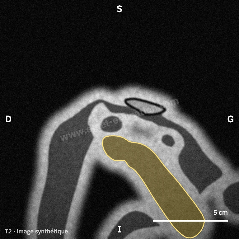 Synthetic MRI, posterior oblique coronal view: the teres minor along the lateral border of the scapula to the humerus.