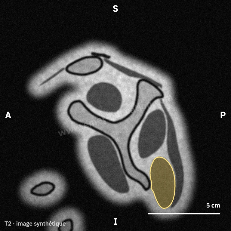 Synthetic MRI, oblique sagittal Y view: teres minor behind and below the scapular body.