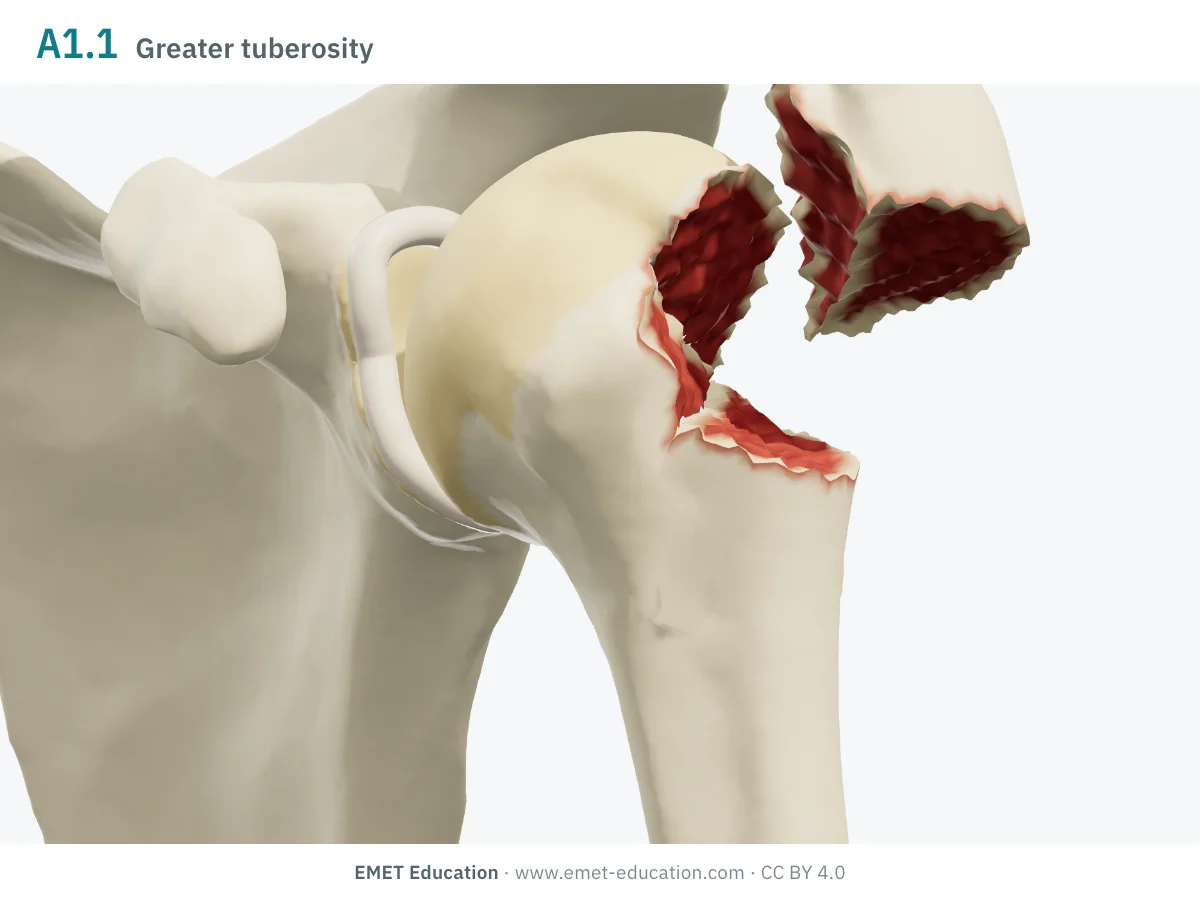 Left shoulder in 3D, front view, code 11A1.1: the greater tuberosity detached, pulled under the acromion.