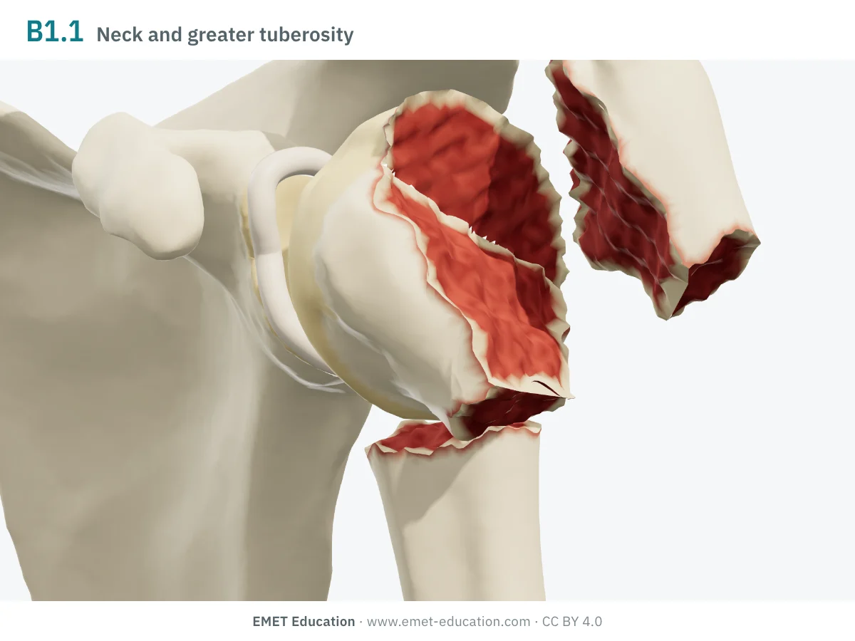 Left shoulder in 3D, front view, code 11B1.1: surgical neck and greater tuberosity fractured, head in varus.