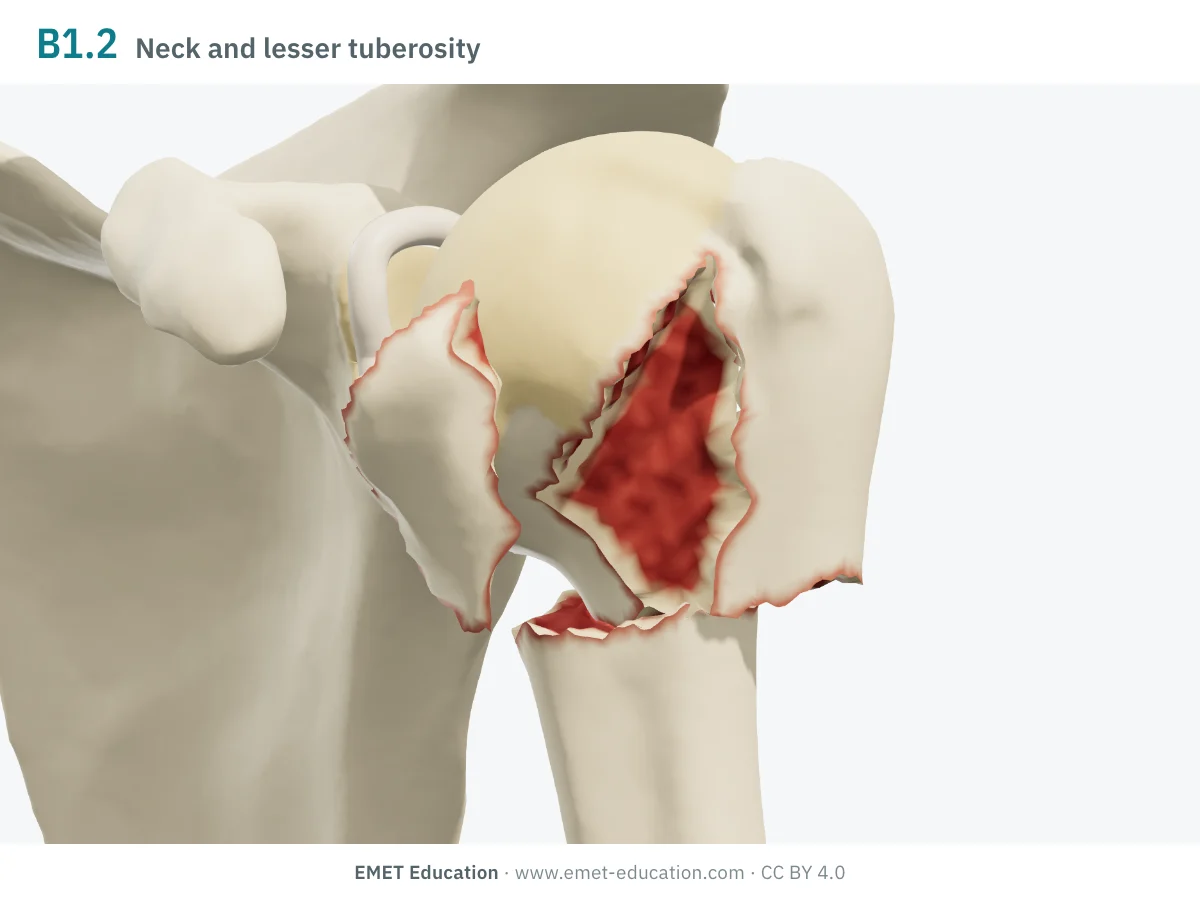 Left shoulder in 3D, front view, code 11B1.2: surgical neck and lesser tuberosity fractured.