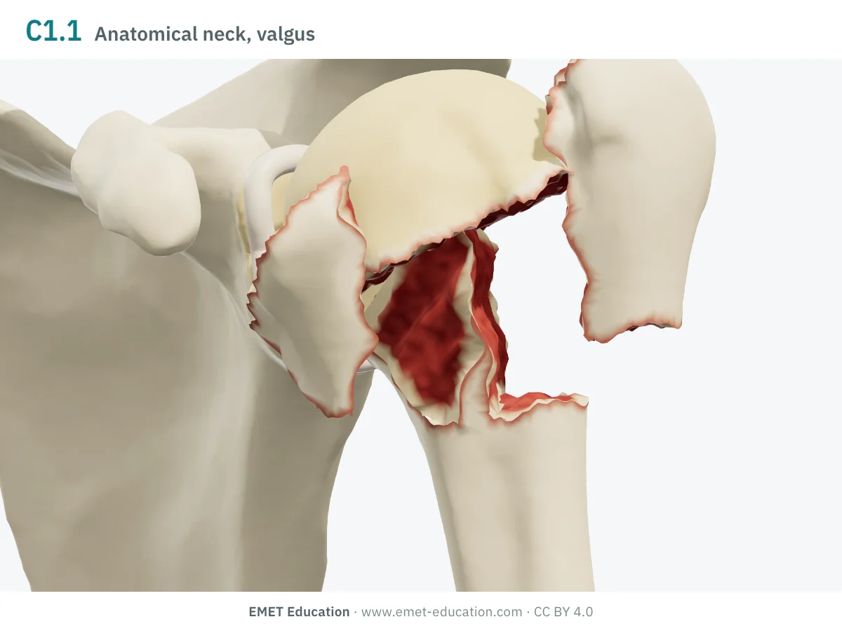 Left shoulder in 3D, front view, code 11C1.1: head impacted into valgus between the splayed tuberosities.