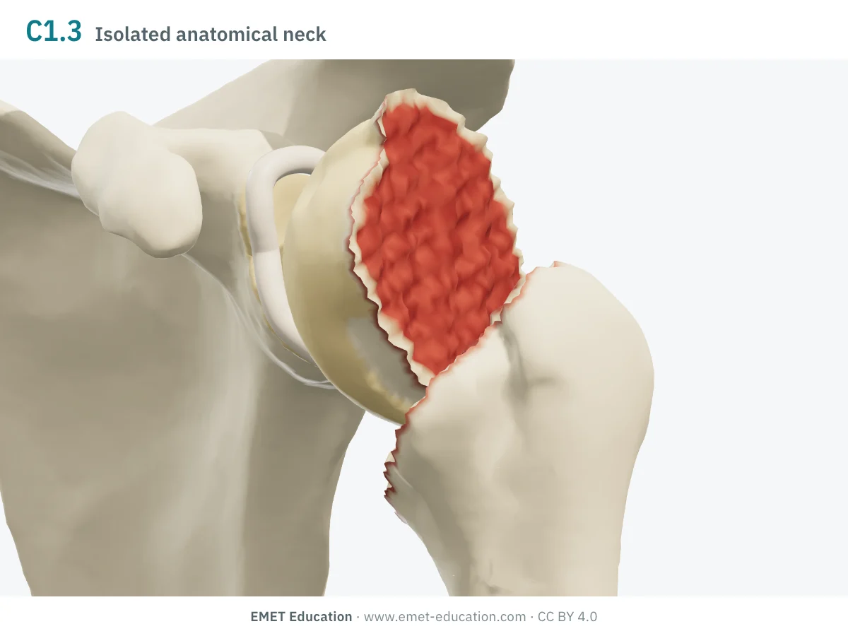 Left shoulder in 3D, front view, code 11C1.3: the head detached at the anatomical neck, tilted into varus.