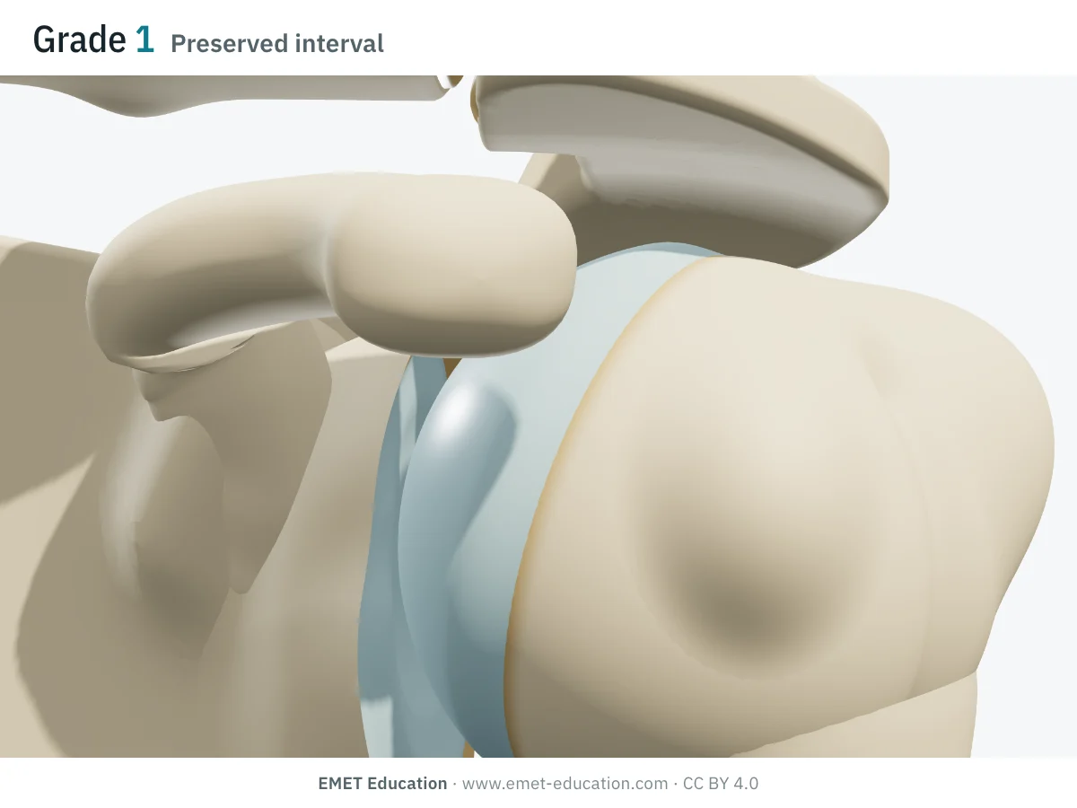 Shoulder in 3D, front view, Hamada grade 1: a clear gap between the humeral head and the undersurface of the acromion, intact cartilage.