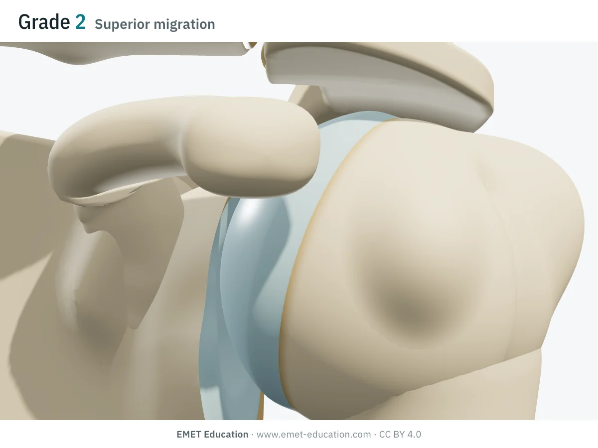 Shoulder in 3D, front view, Hamada grade 2: the humeral head has moved up under the acromion, the subacromial space is narrowed.