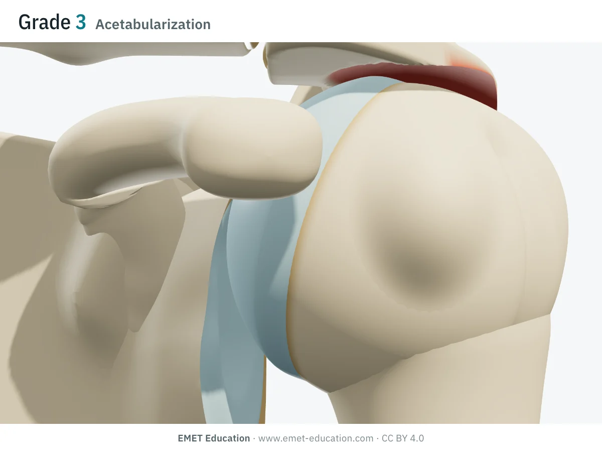 Shoulder in 3D, front view, Hamada grade 3: undersurface of the acromion hollowed and reddened where the head bears, greater tuberosity rounded off.