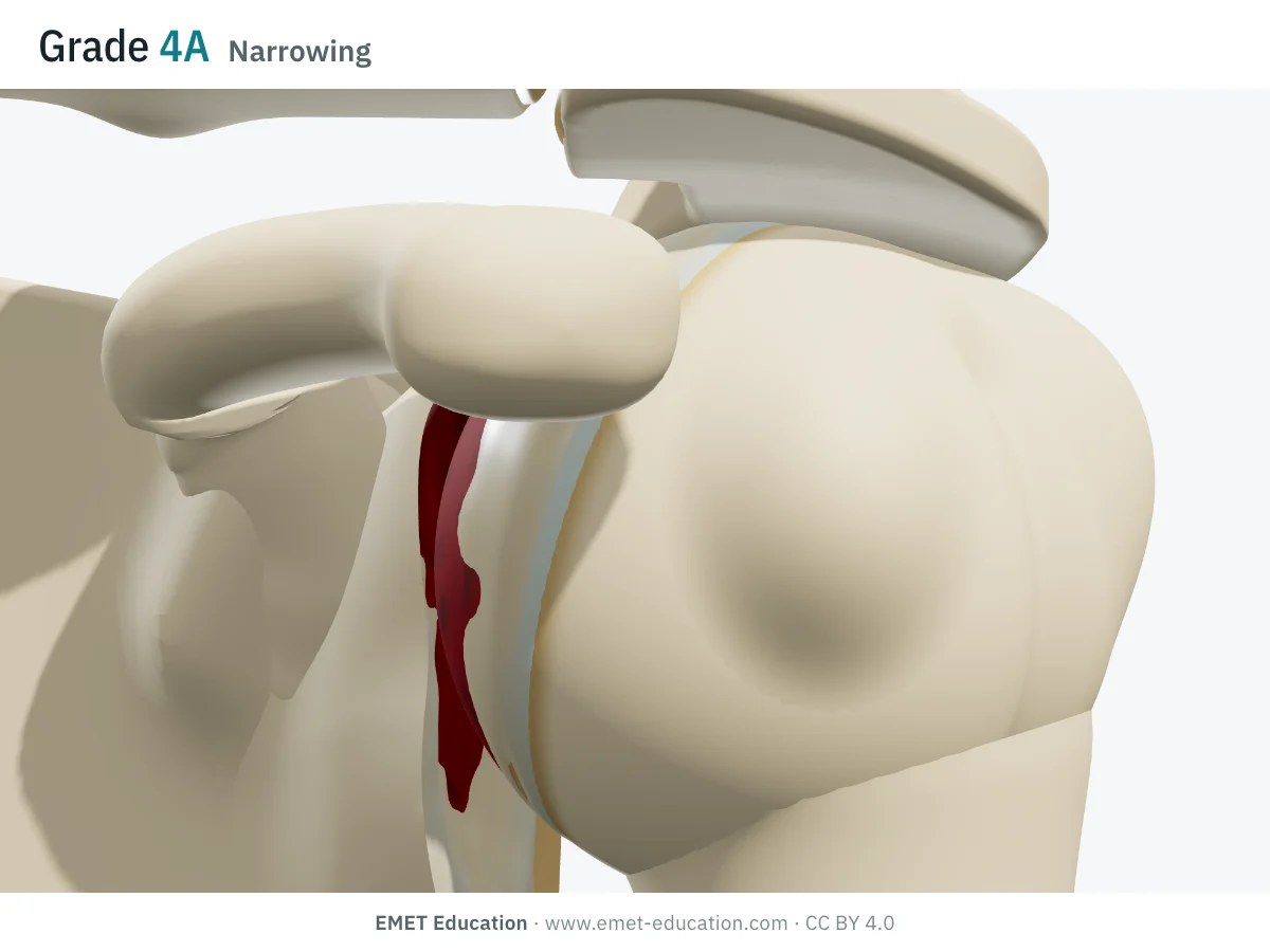 Shoulder in 3D, front view, Hamada grade 4A: narrowed glenohumeral joint space, worn and red upper glenoid, acromion of normal shape.